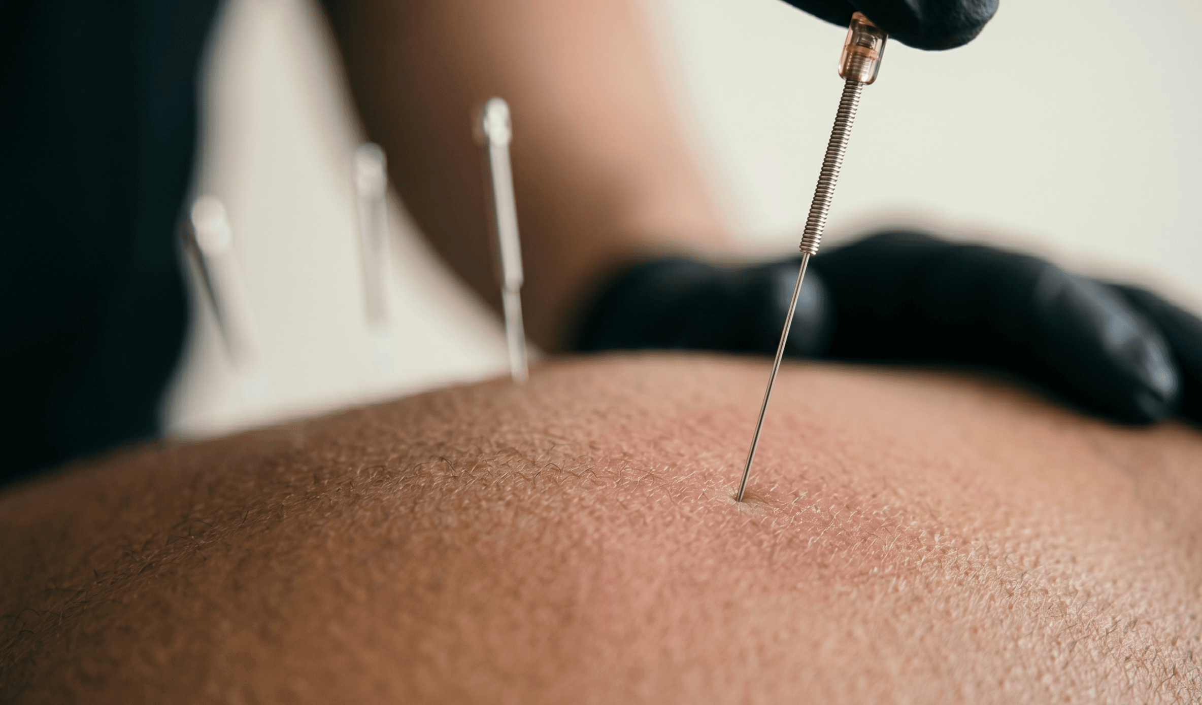 Dry Needling