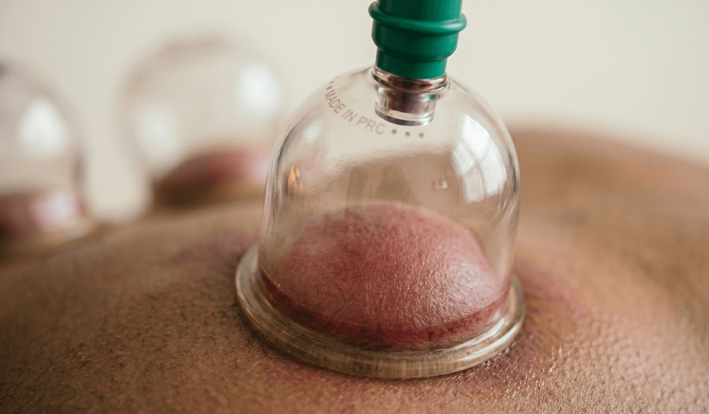 Cupping